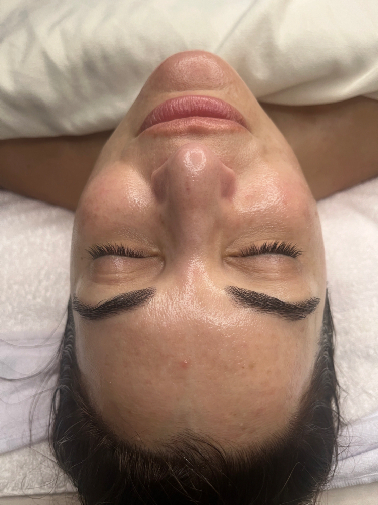 Microdermabrasion