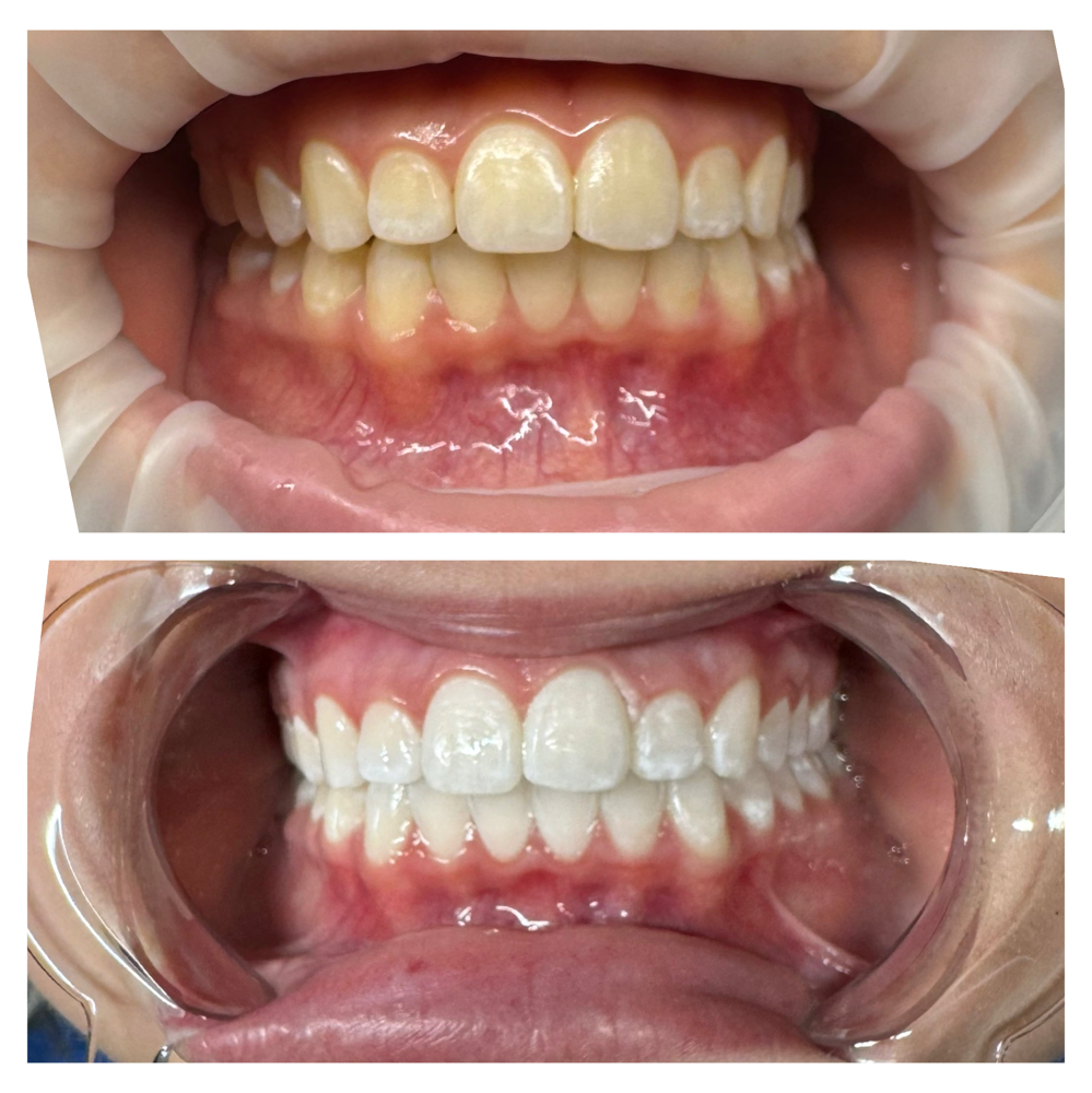 Teeth Whitening at The Cosmetic Ardis in Goldsboro, NC