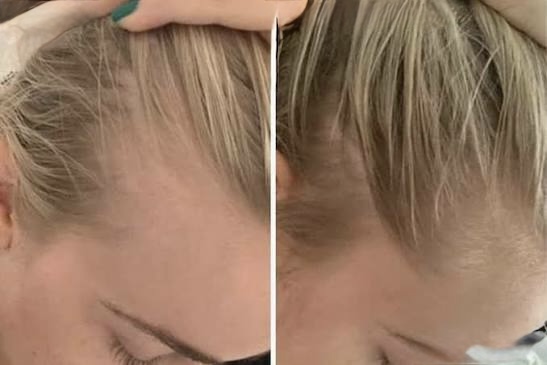 Scalp Micro at RAE Aesthetics in Hudson, OH