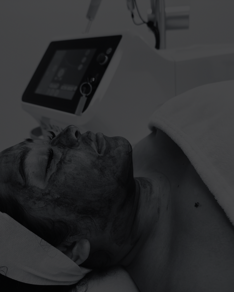đź’Ž Carbon Laser Facial