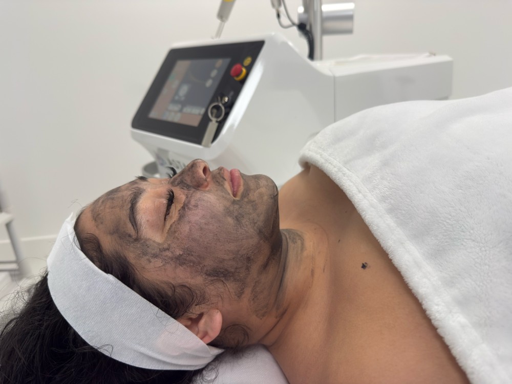 💎 Carbon Laser Facial