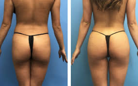 5D Butt Lift -10 session