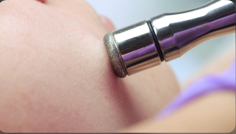 Microdermabrasion