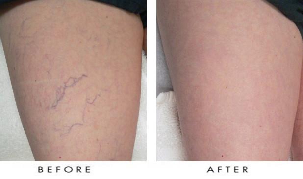 Spider Vein Removal