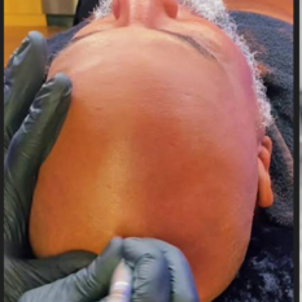 Men’s Scalp Treatment (Bald Head ) at Melodic Roots & Wellness in Windsor Mill MD, MD