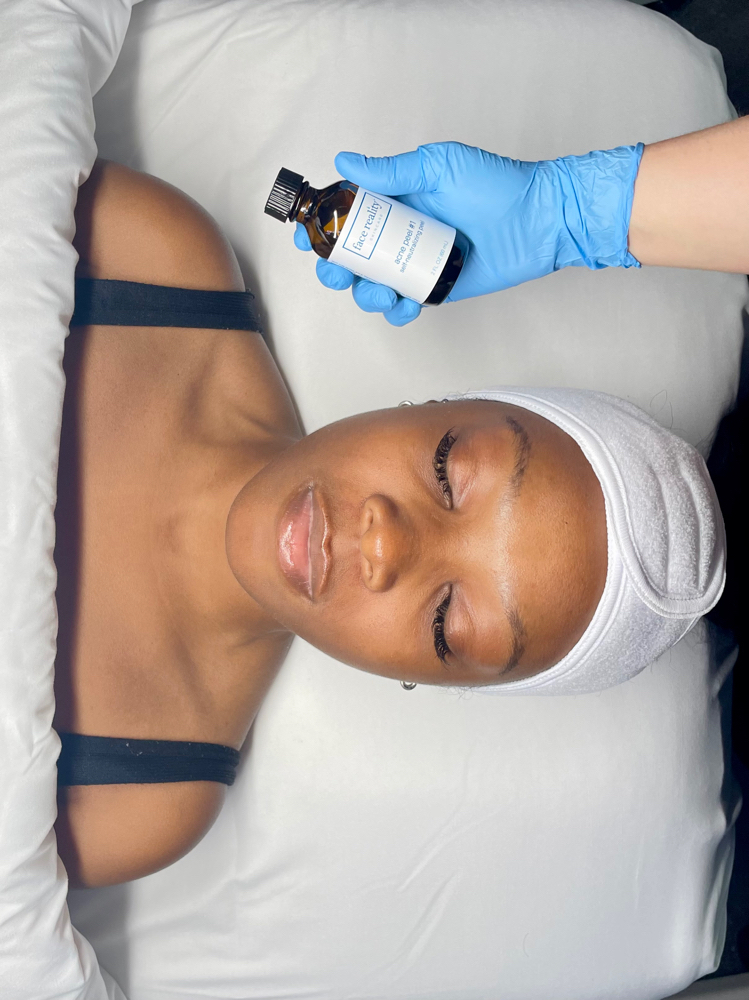 Light Chemical Peel