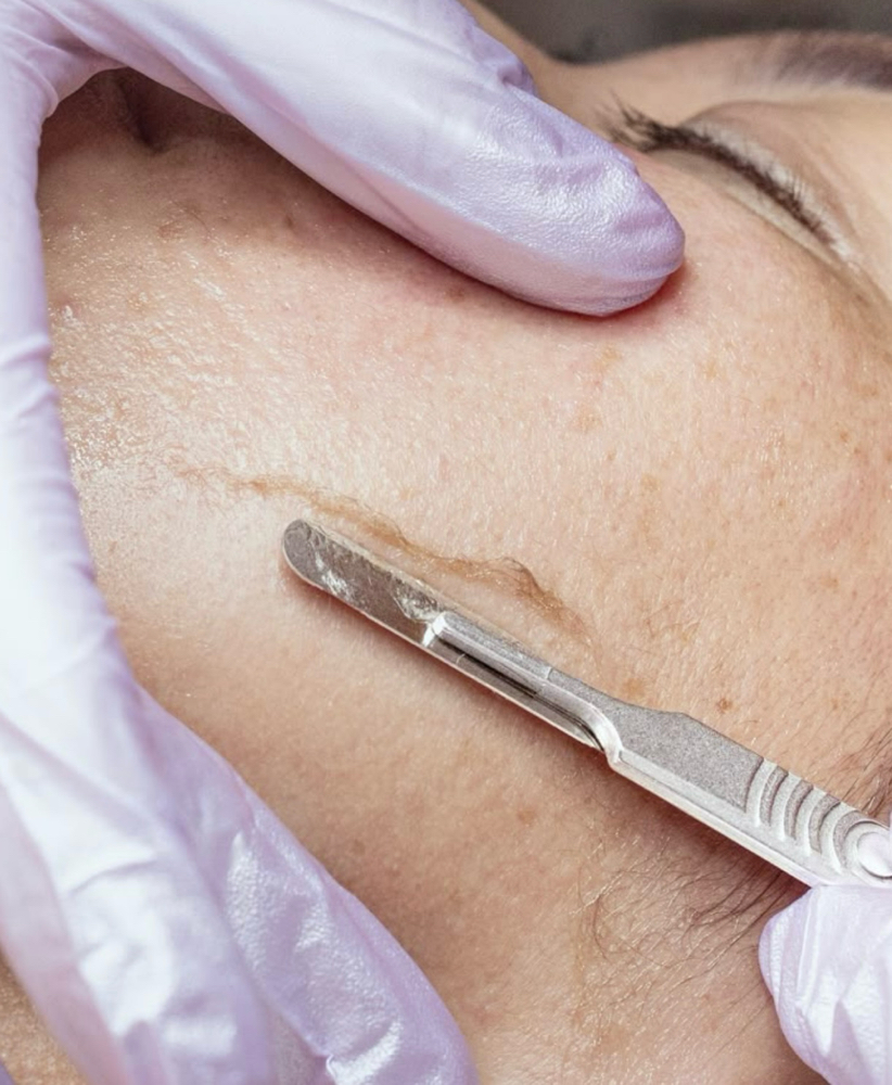 Dermaplane Facial at Glow Crazy Esthetics in Saint Joseph, MO