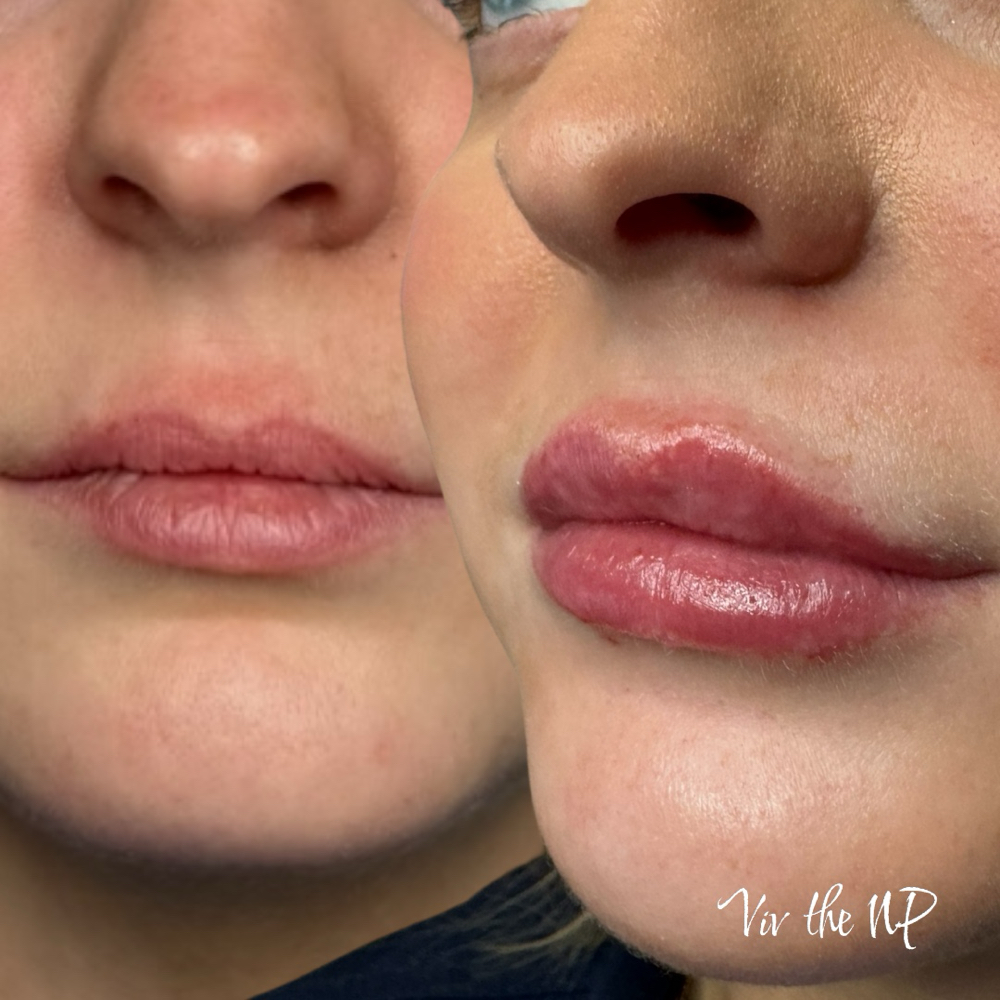 Full Syringe Lip Filler