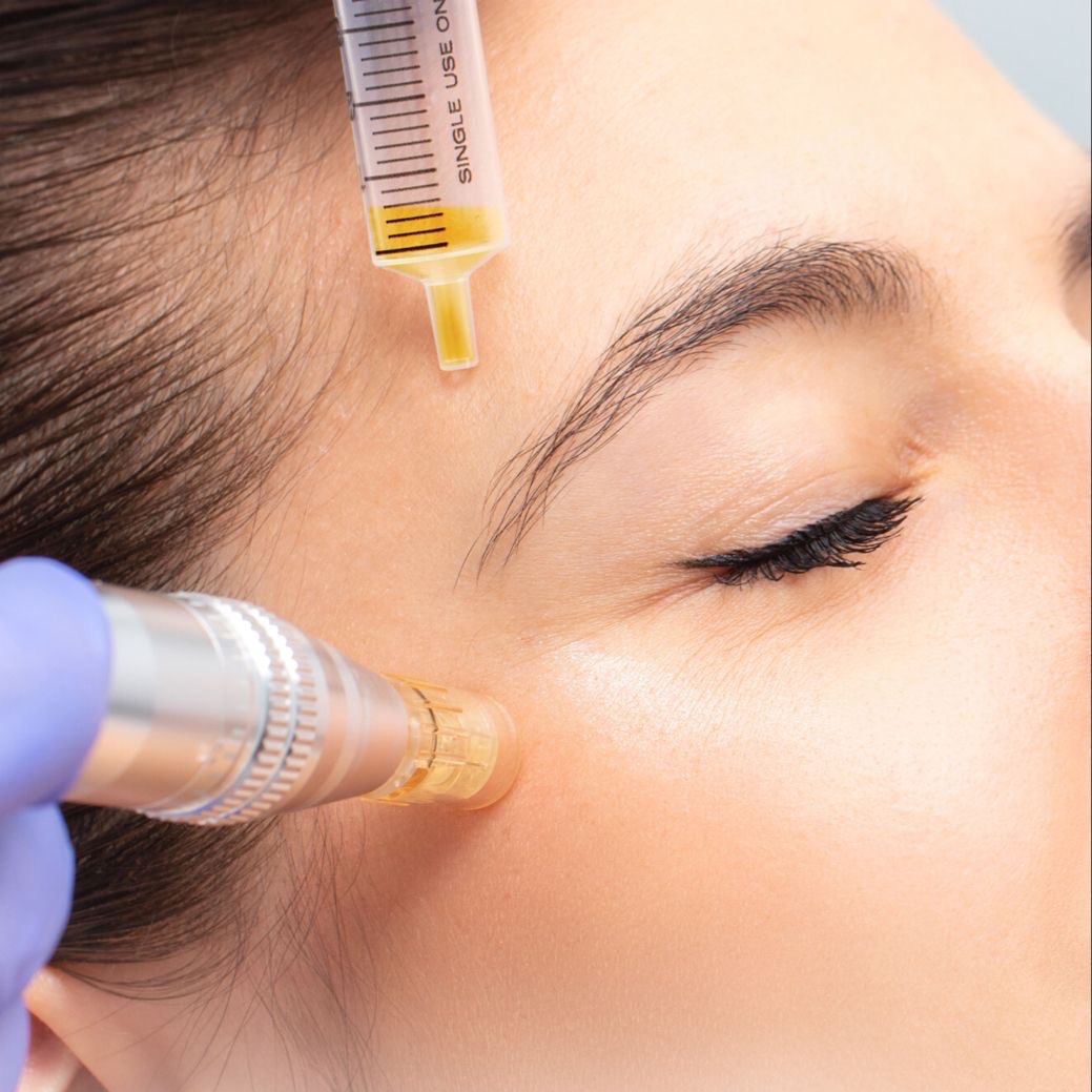 MICRONEEDLING PRP at Lavana by Remake in Edinburg, TX