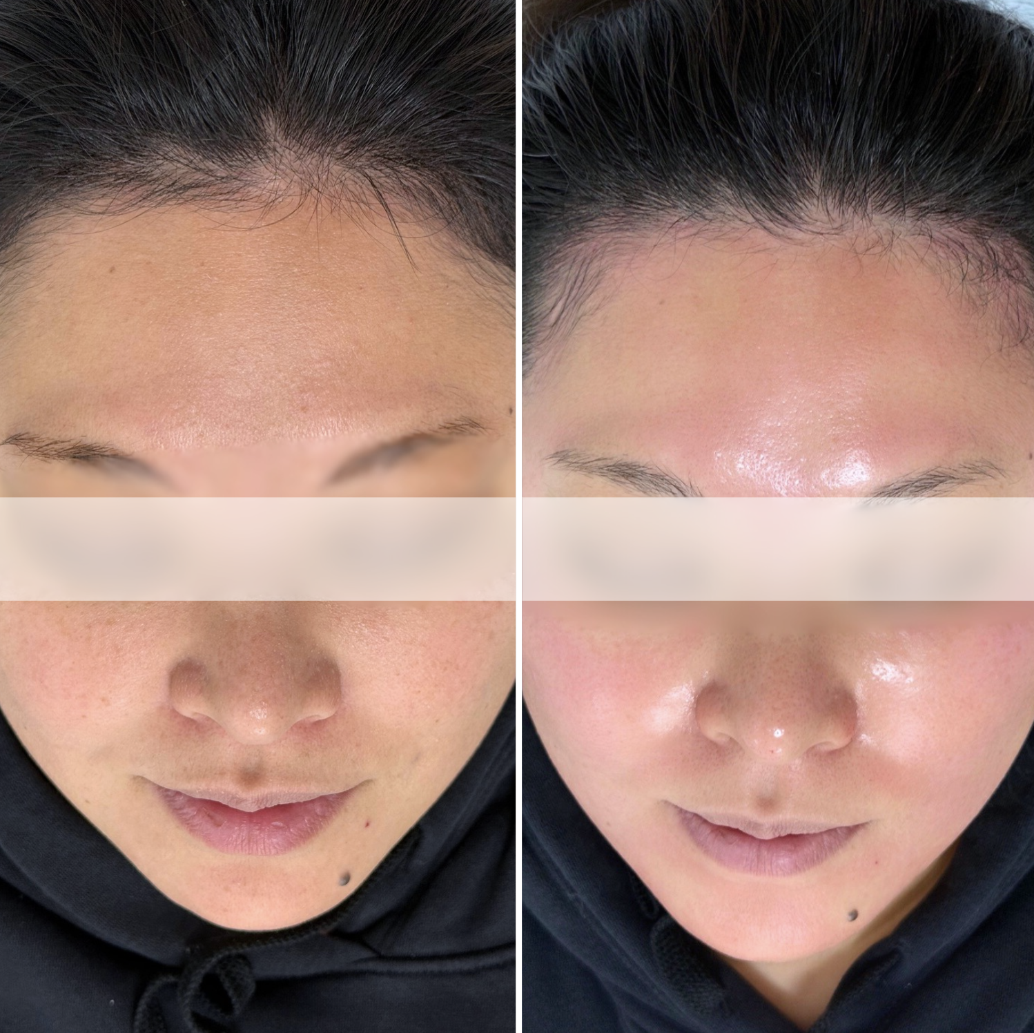 Superjection 3D Microneedling