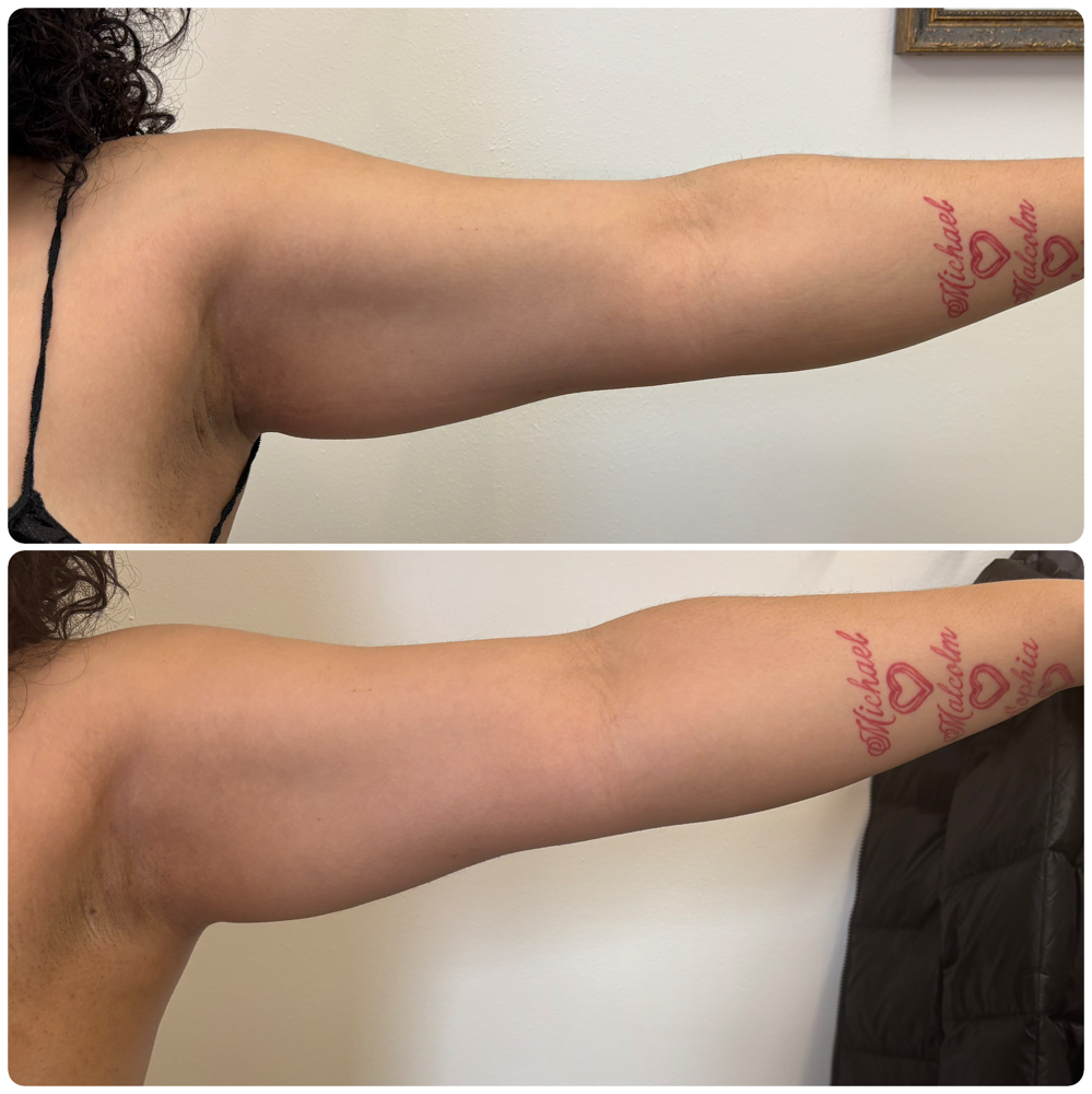 Arm Sculpt (1 Session)