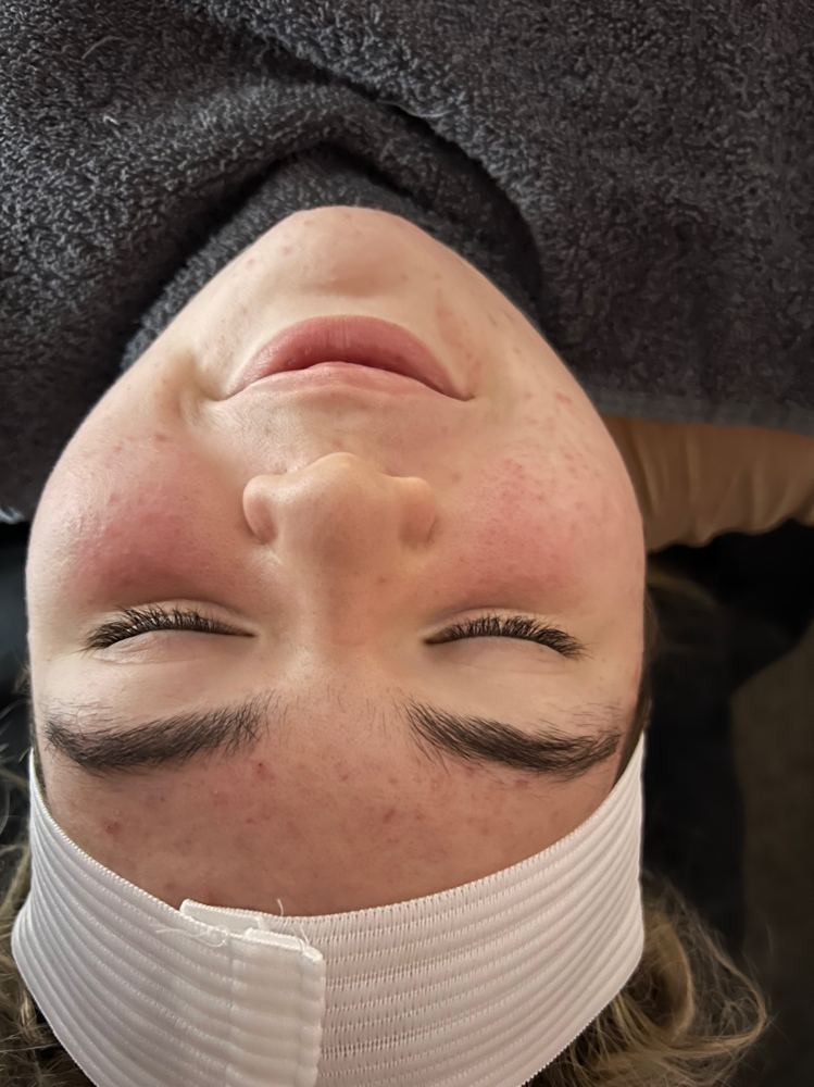 Acne Treatment Facial