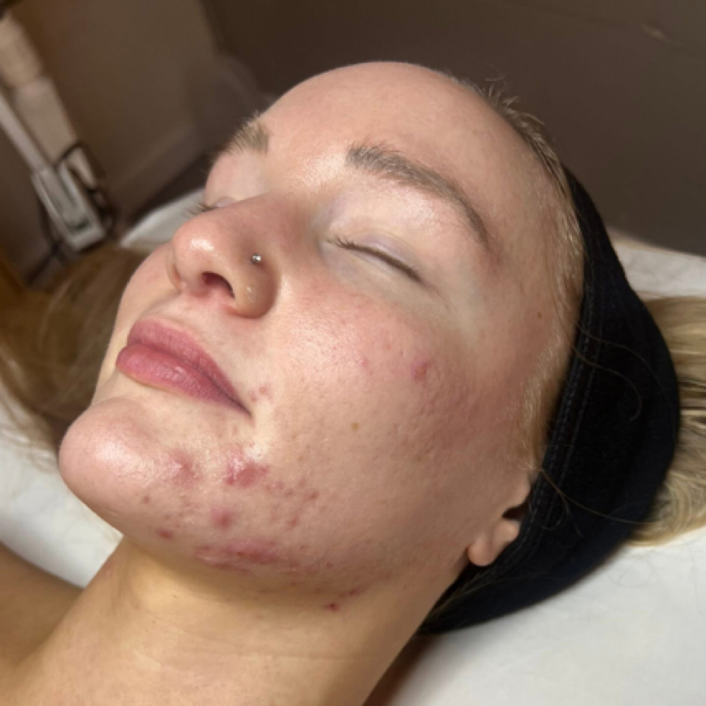 Acne Facial at TheKayEsthetics in Owensboro, KY