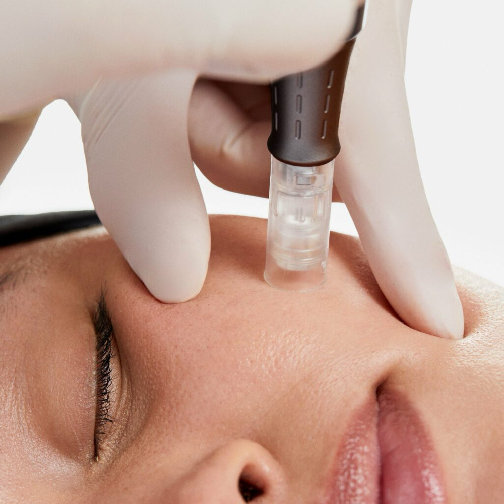 Nano-Needling Facial