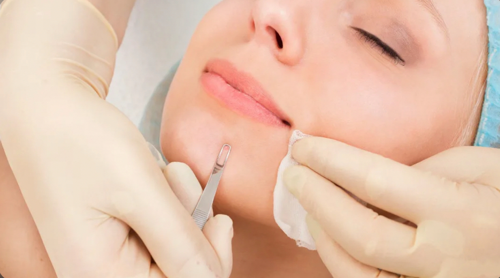 Extractions (ADDED TIME)