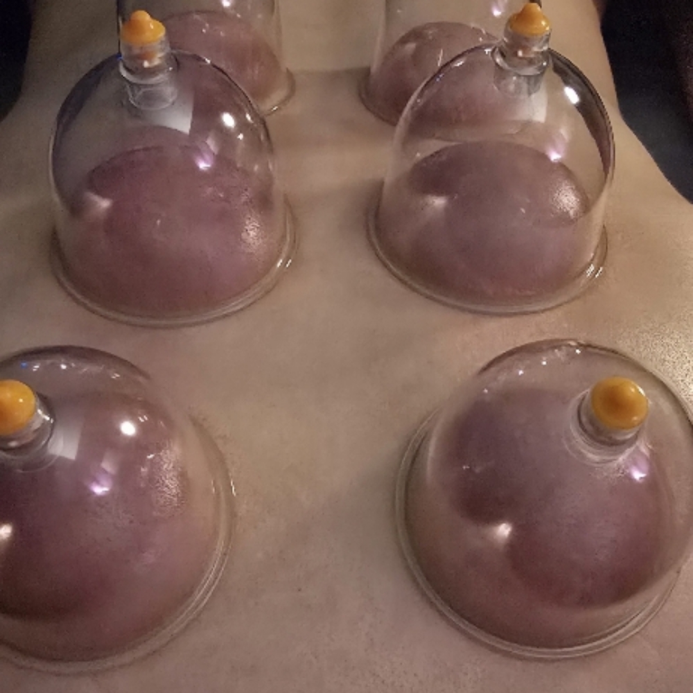 Decompression Therapy(Cupping) at Kinetic Myofascial & Therapeutic Massage in Downers Grove, IL