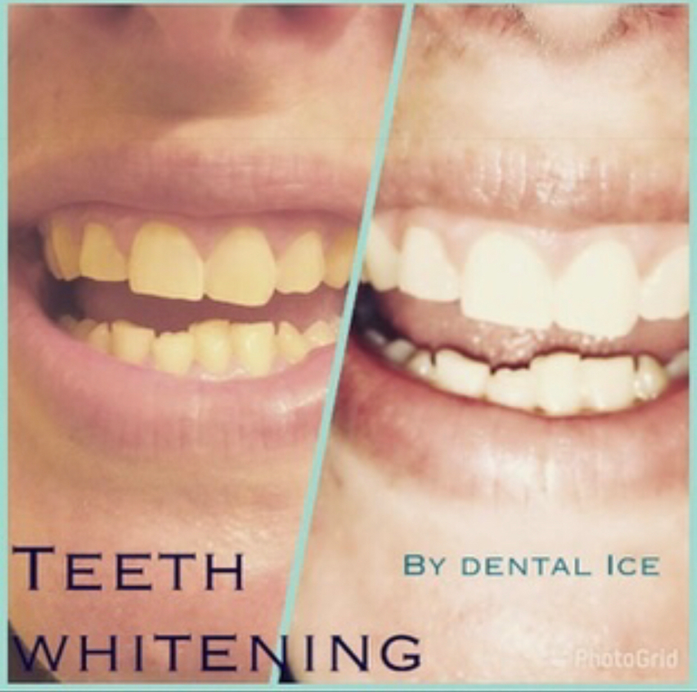 Teeth Whitening