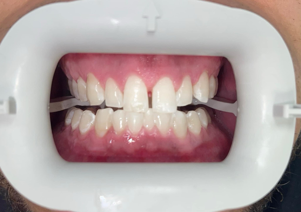 Teeth Whitening 6-Month Touch Up
