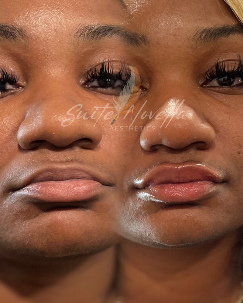 Soft Lips – Private Client Rate
