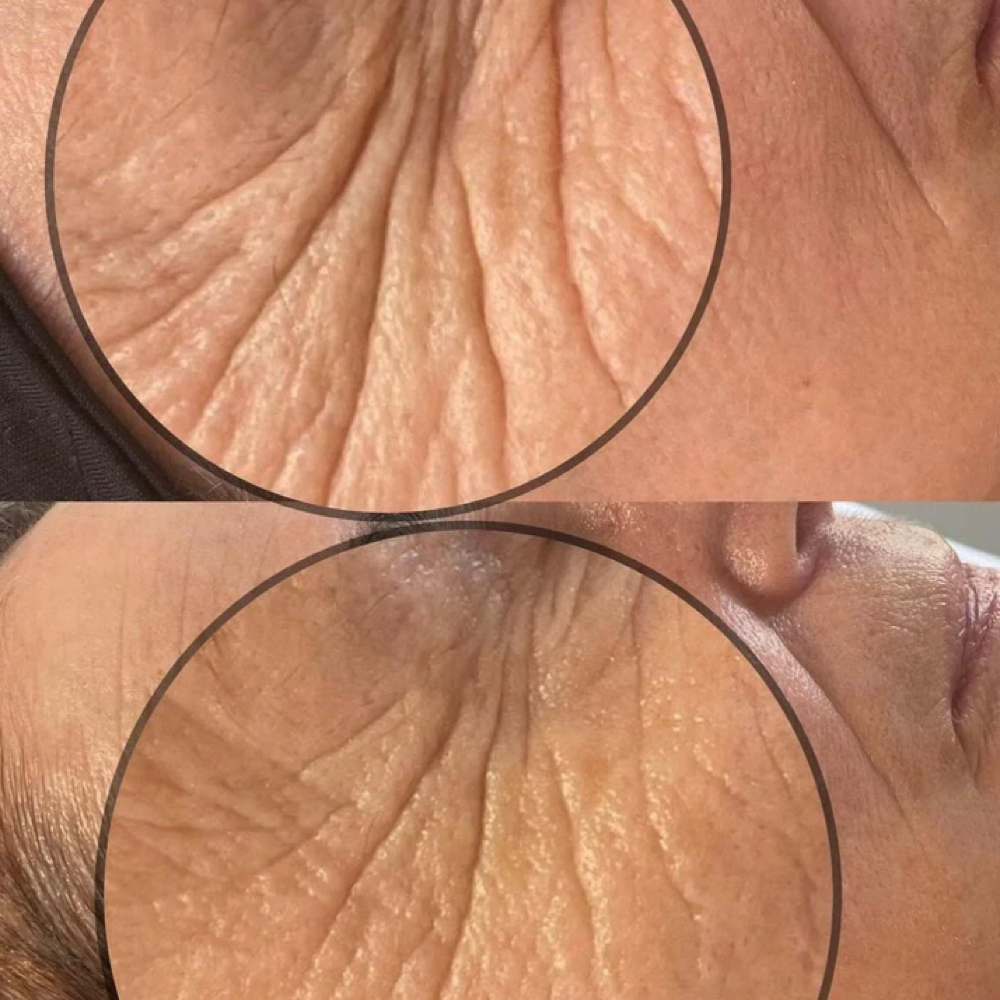 Carbox + Vtox Facial at The Reve Esthetics in Yukon, OK
