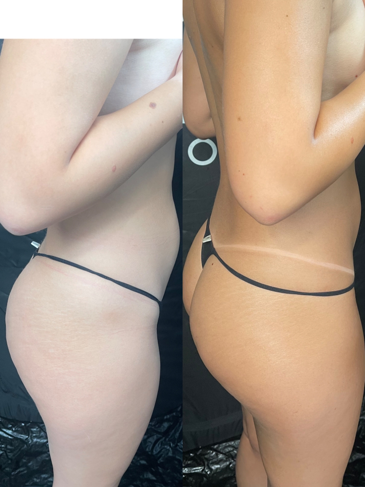Spray Tan