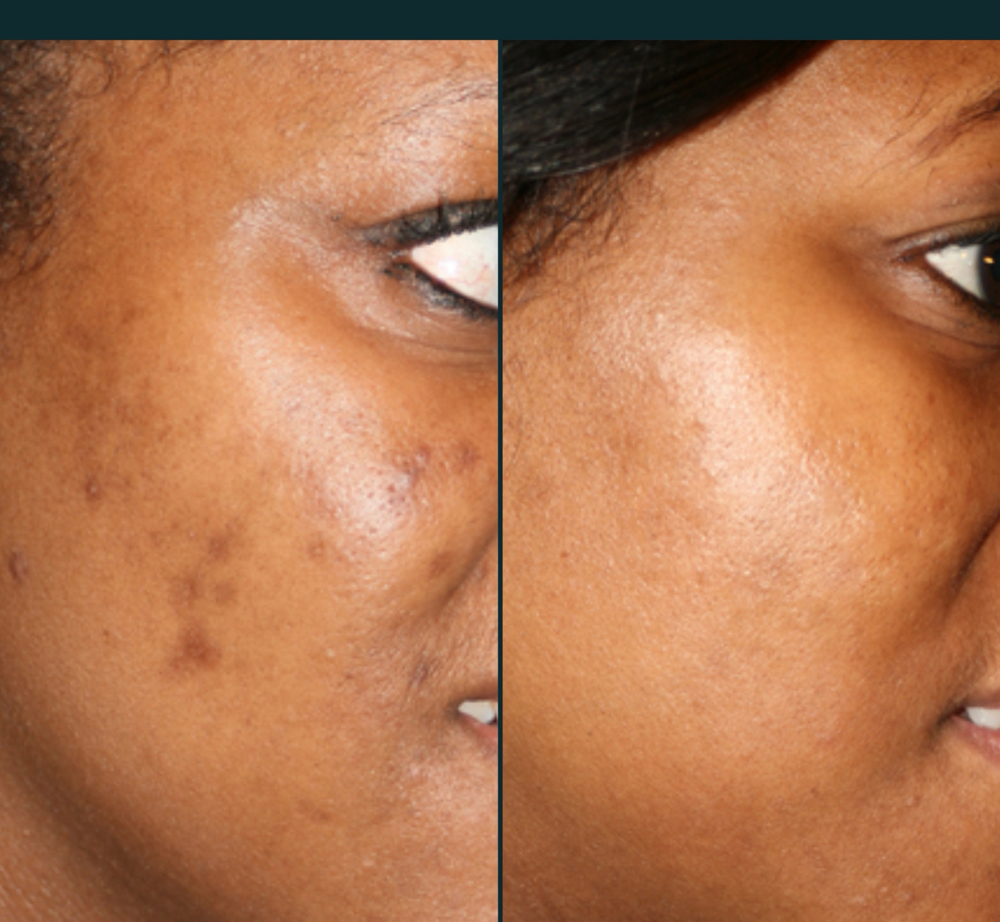 ✨ The Perfect Derma™ Peel
