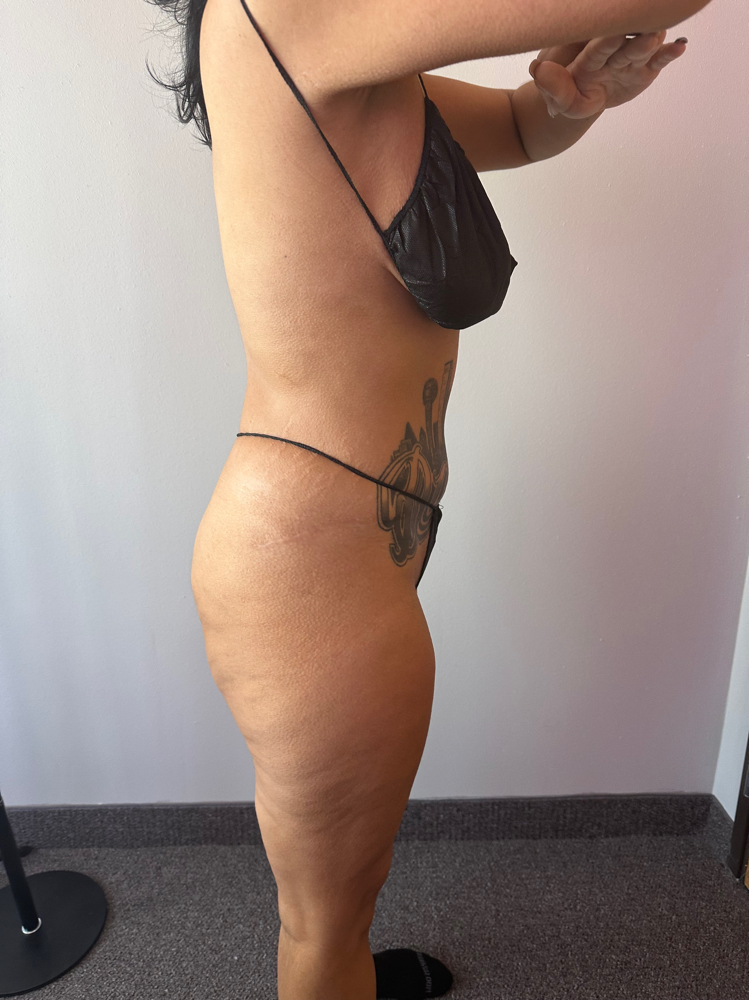 Body Contouring Training Fort Worth