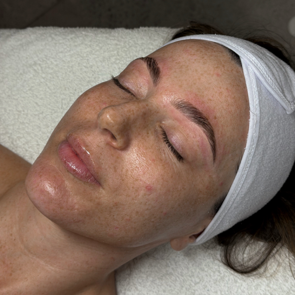 Signature Dermaplane at Ruby Williams Aesthetics LLC in Sarasota, FL
