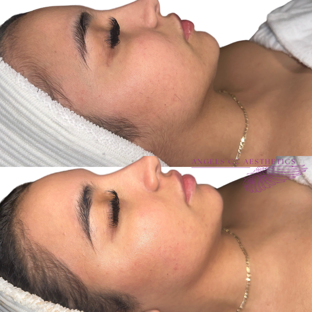 Dermaplane Facial at Angels Aesthetics ABQ in Albuquerque, NM
