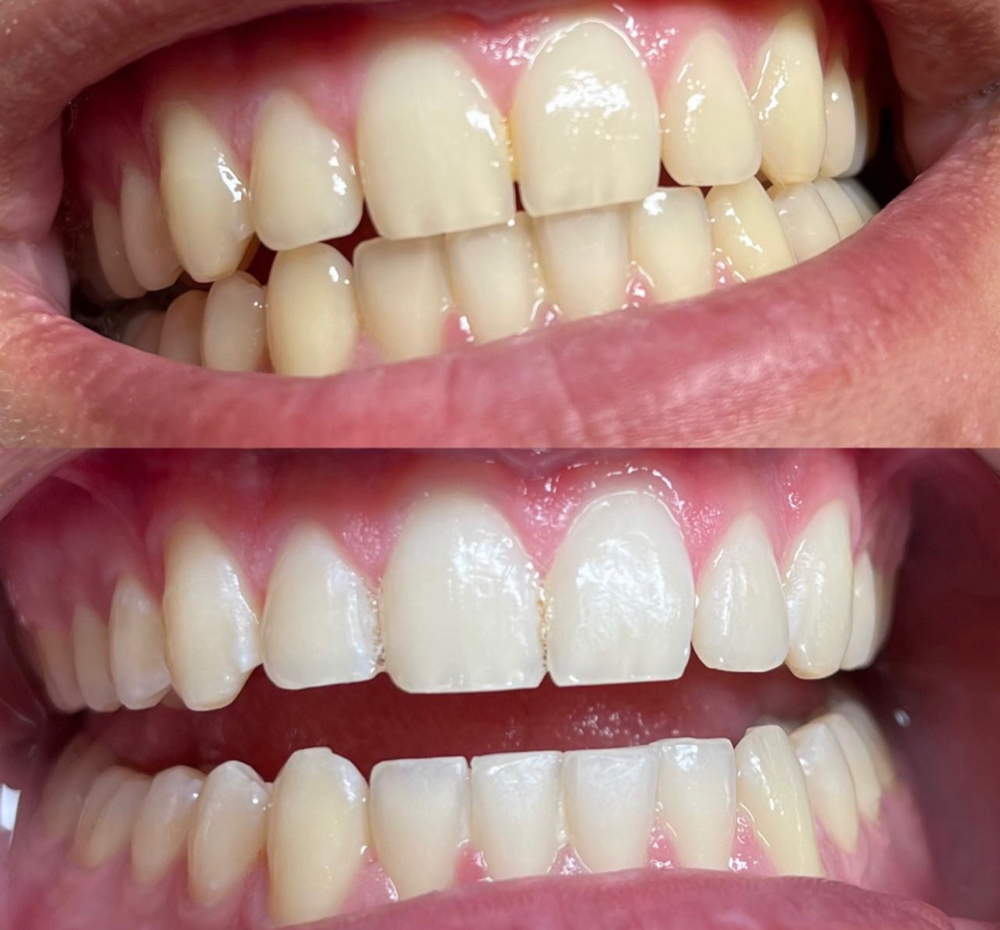 40 Min Teeth Whitening Session