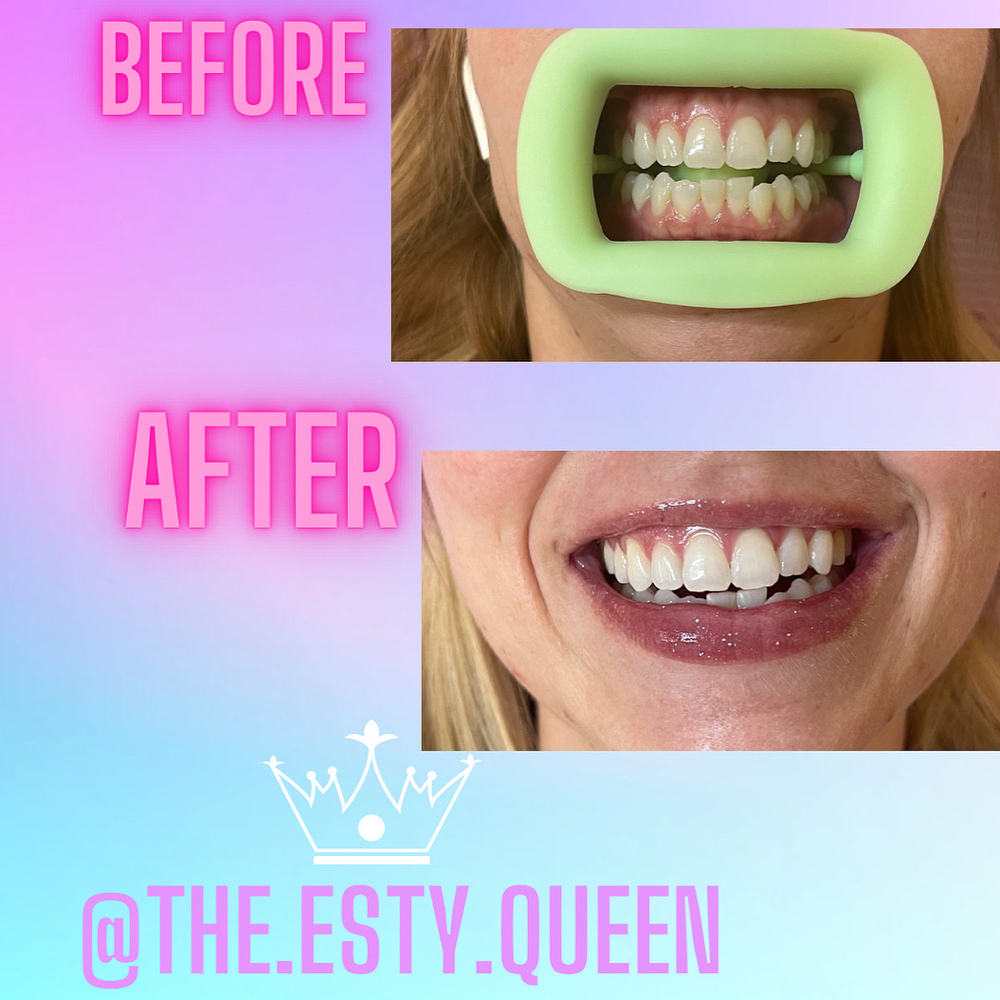 30min Teeth whitening