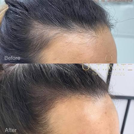 SMP: Temple hairline Restoration