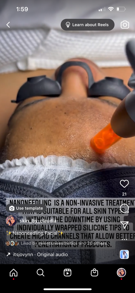 Nanoneedling Facial