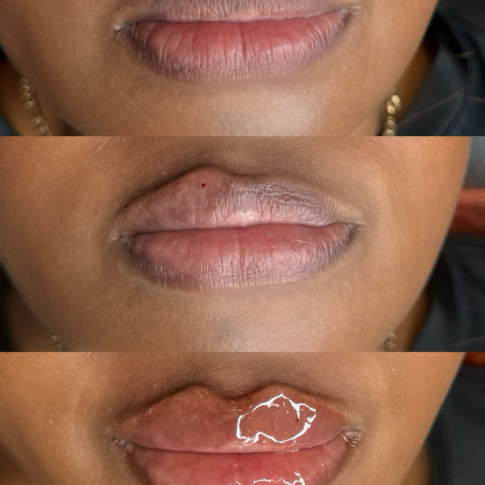 Lip Filler at Preddy and Penk Salon in Chicago, IL