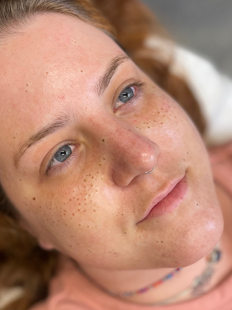 Freckles