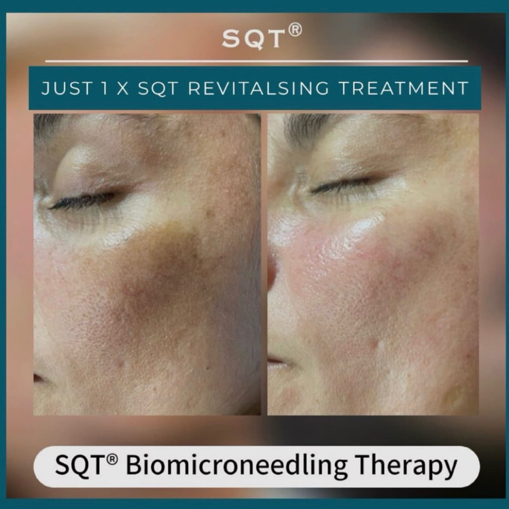 SQT Bio-Microneedling Treatment at Polished Pearl in Columbus, OH