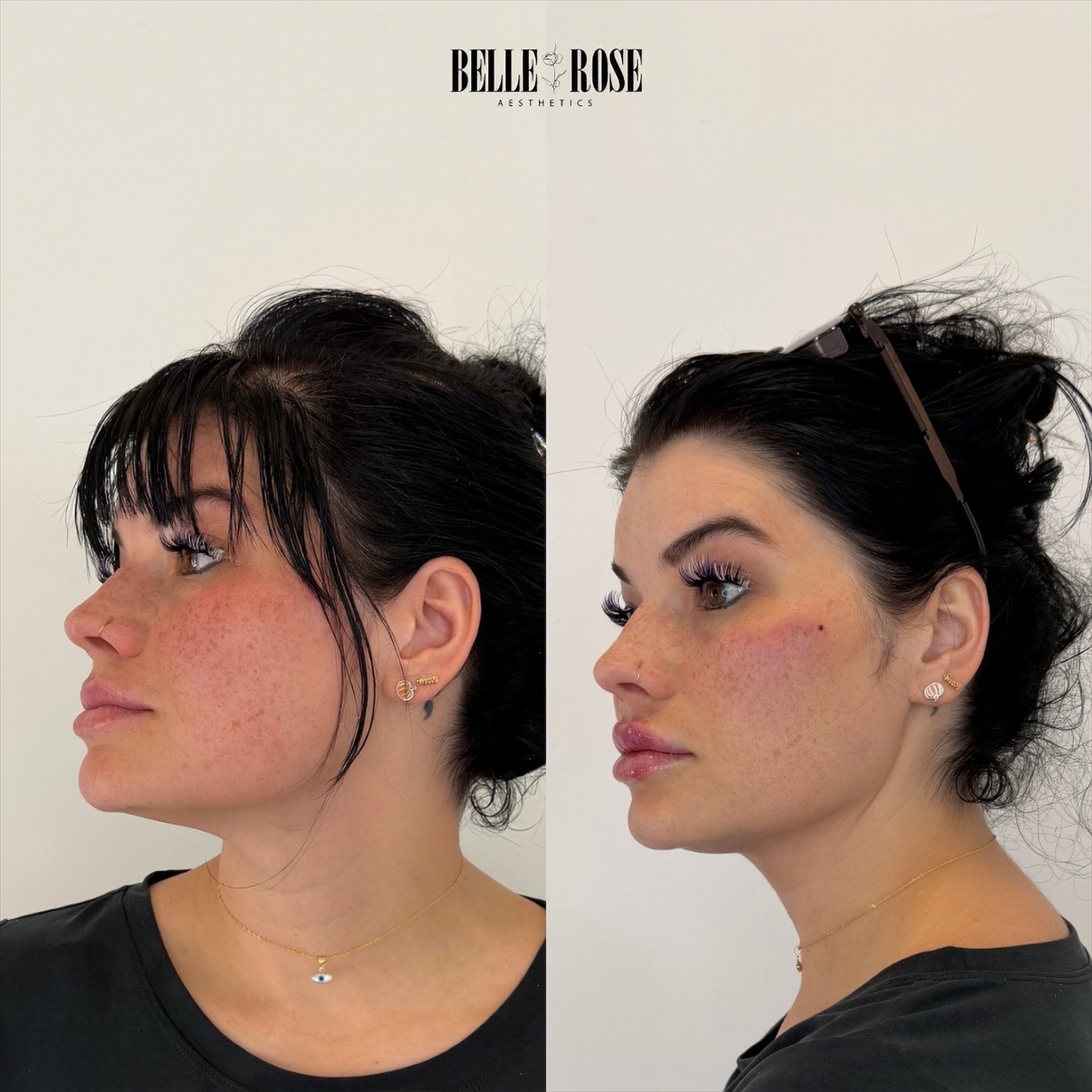 PRP - PLATELET RICH PLASMA