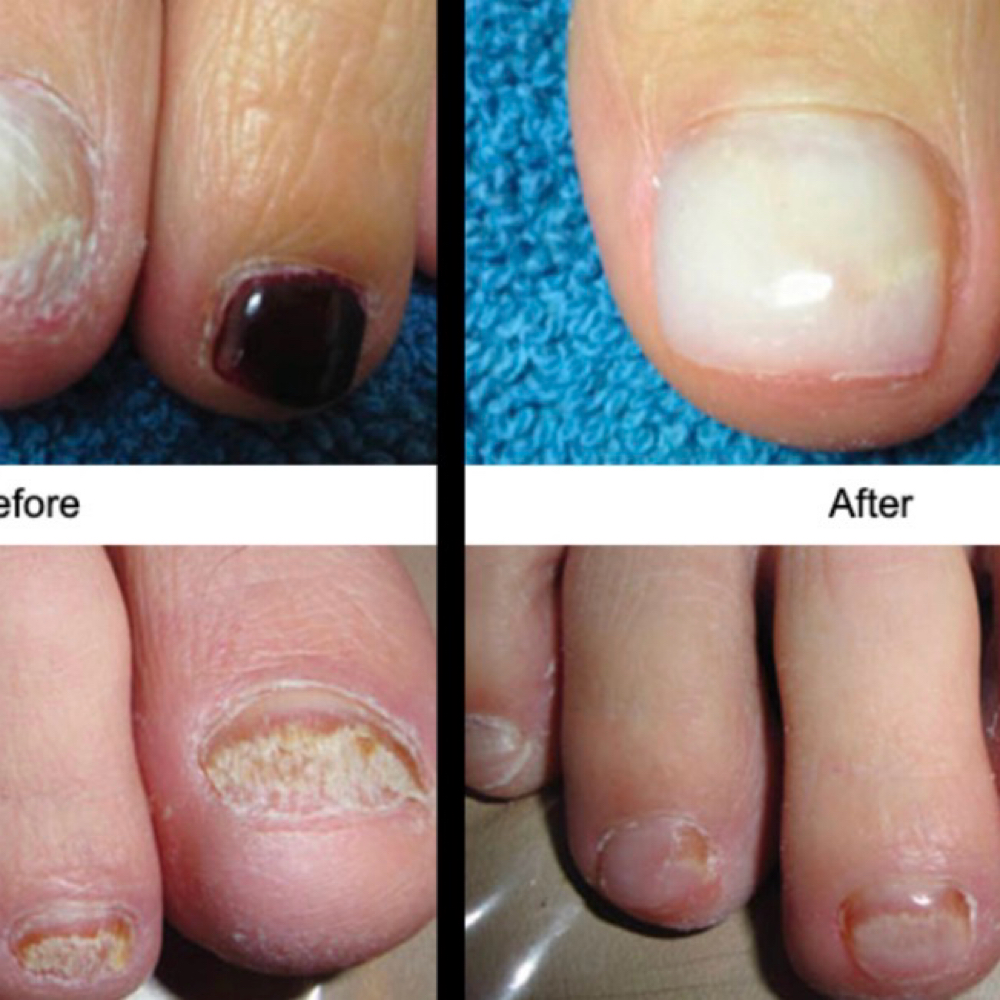 Fungal Cleaning (Returning) at Selis.Studio in Riverside, IL