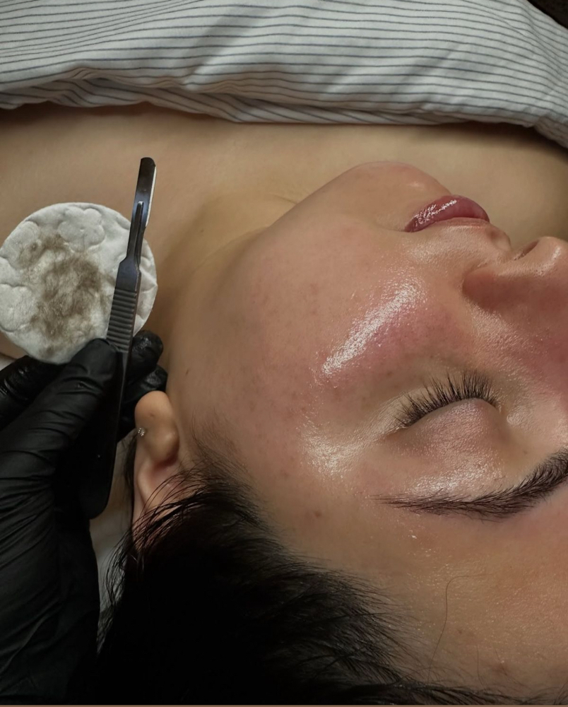 Dermaplane Facial