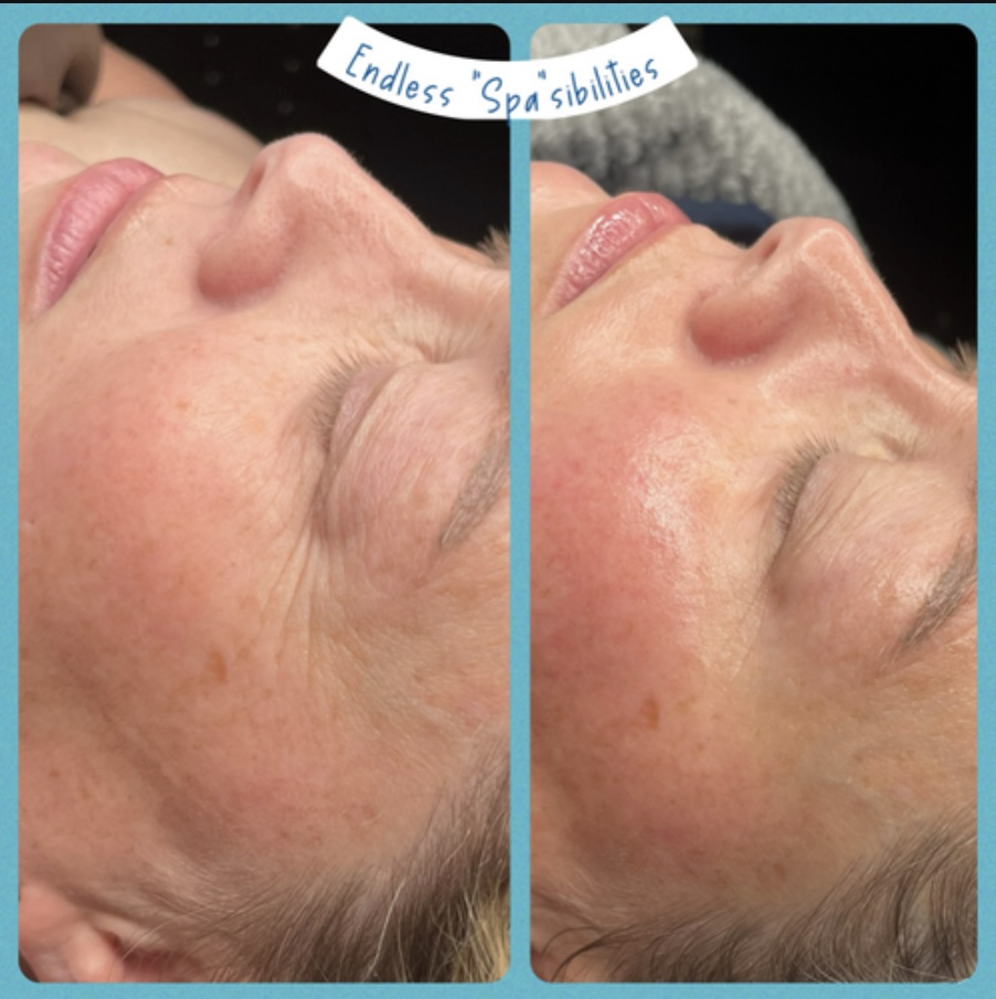 Microchanneling Treatment