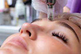 Express Microneedling Treatment