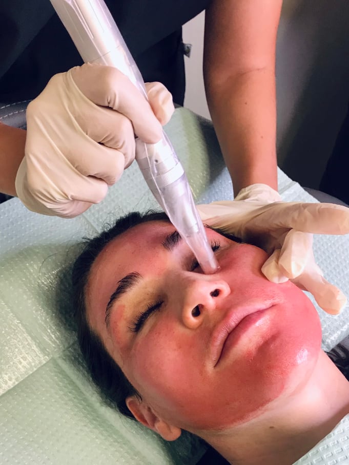 Salmon DNA Microneedling