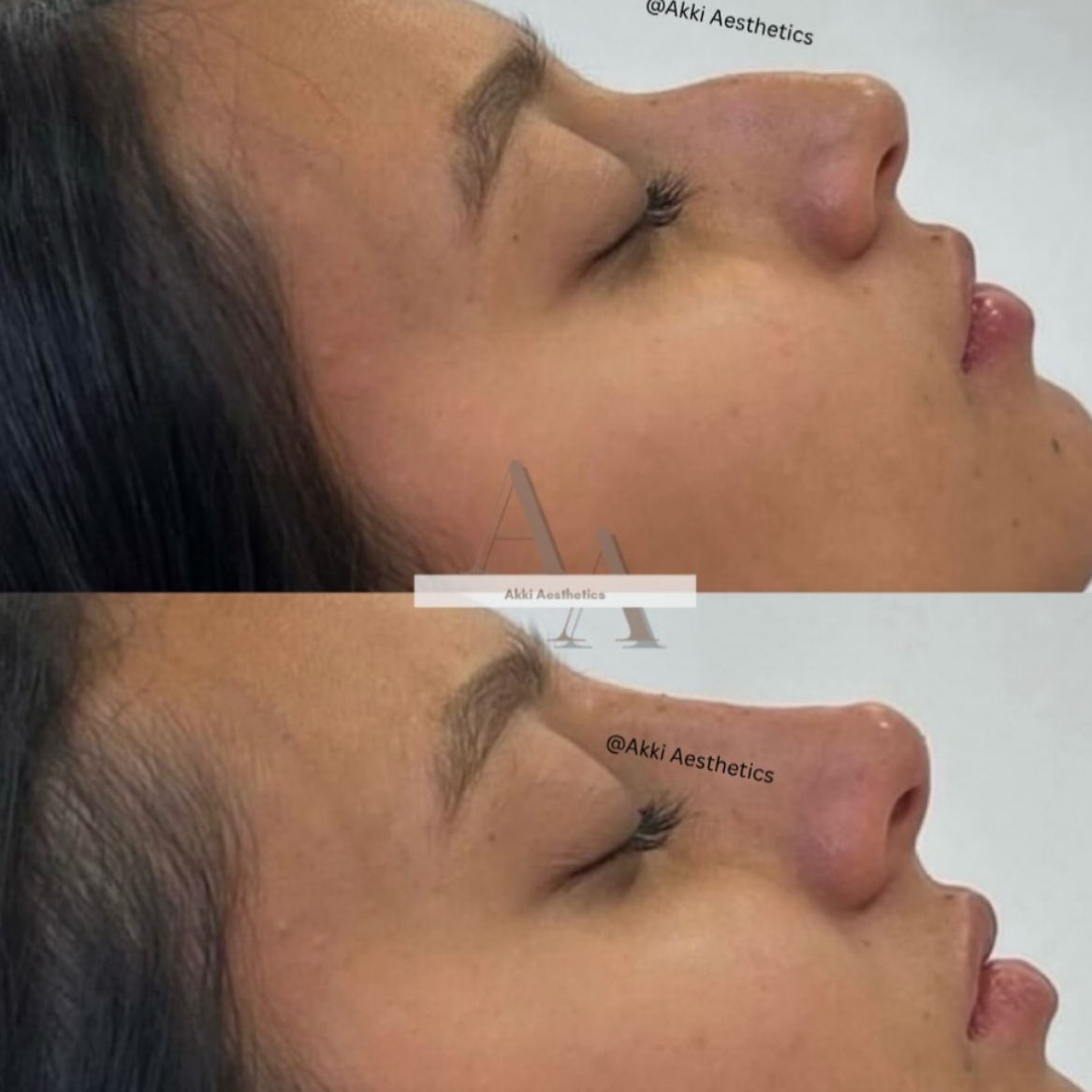 Liquid Rhino (Nose Filler) at Akki Aesthetics in Williston Park, NY