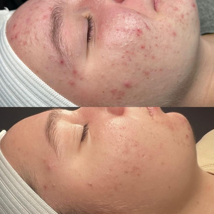 Face Reality Acne Bootcamp