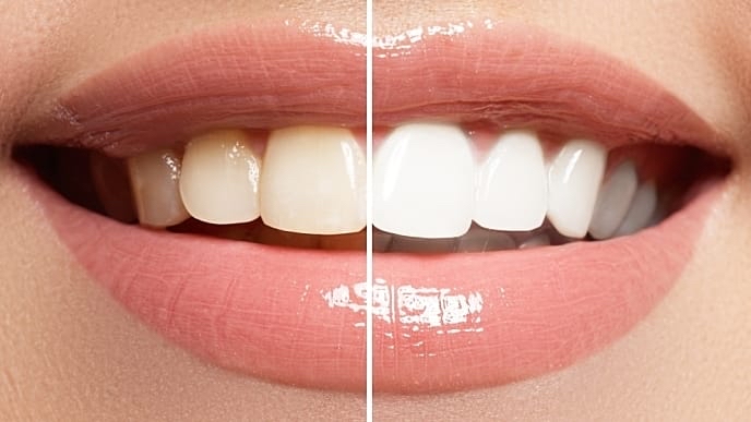 Teeth Whitening (2 sessions)