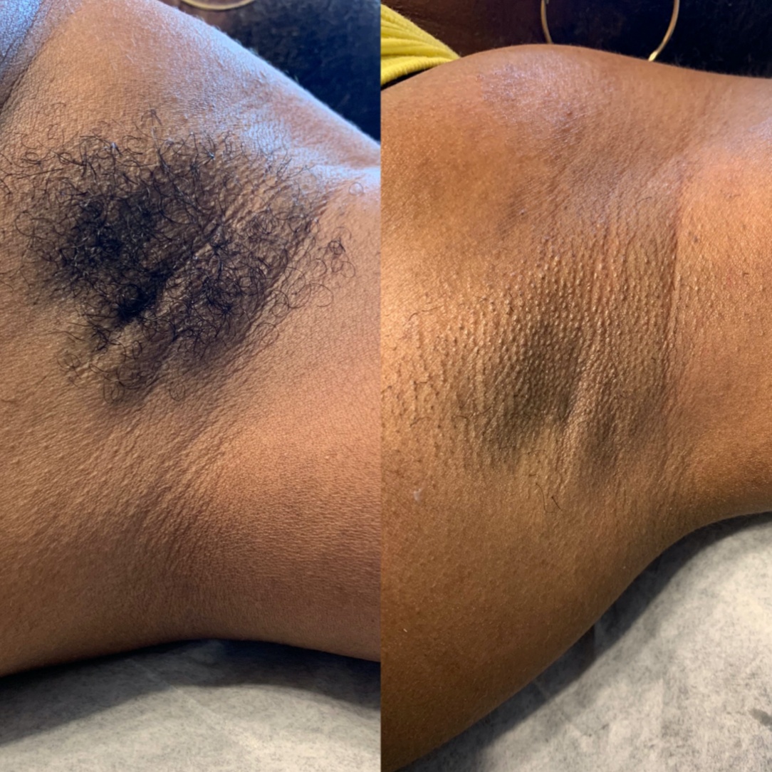 Underarm Wax at Adiya Esthetics in Jonesboro, GA