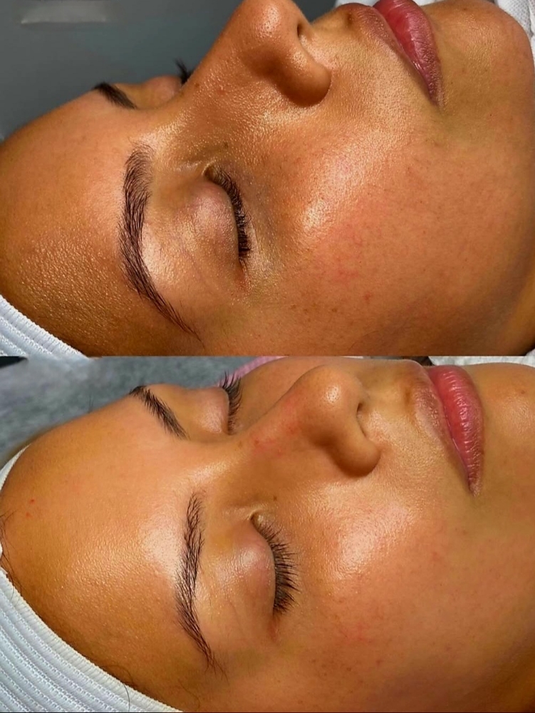 Dermaplaning Treatment
