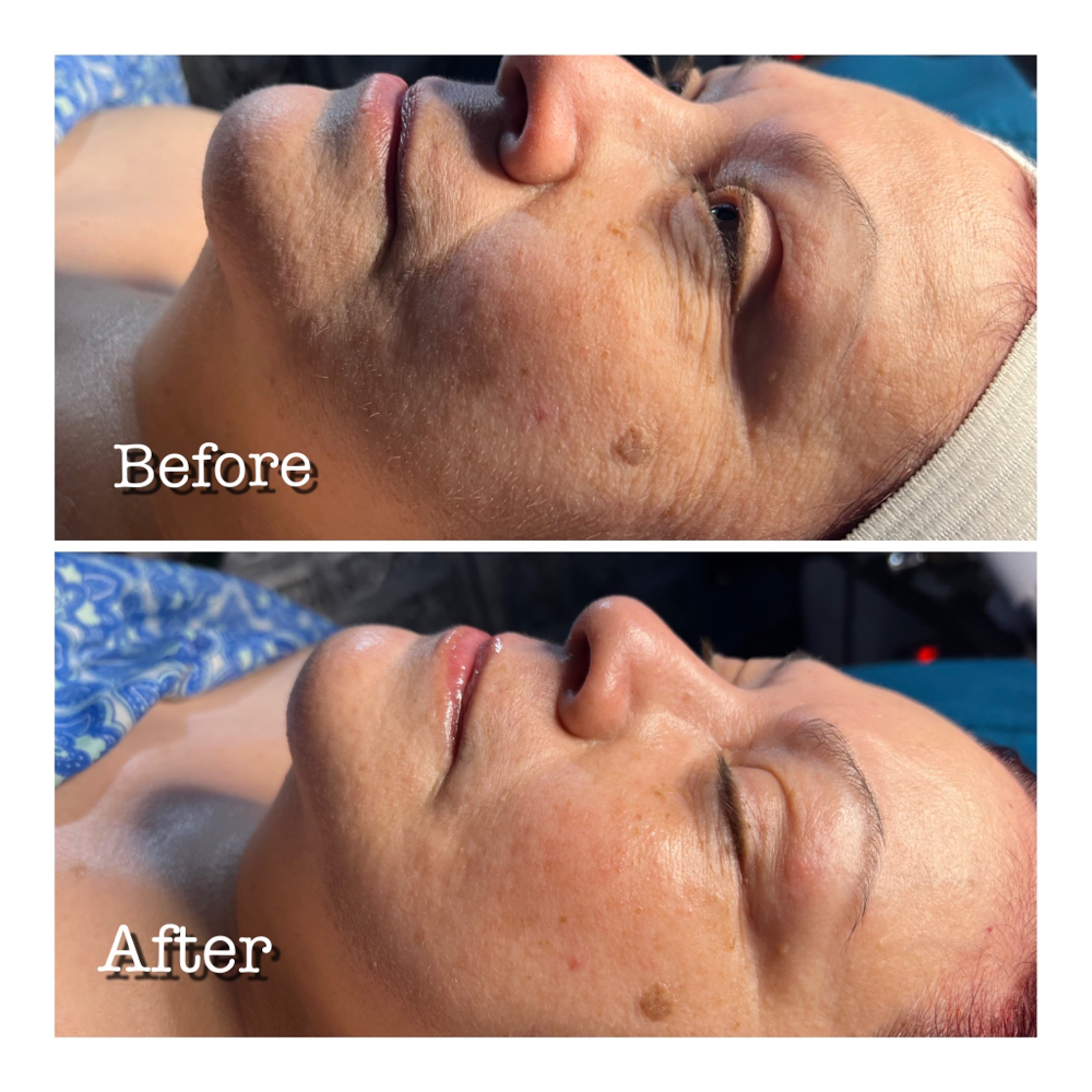 Firming Peptide Treatment With Facu