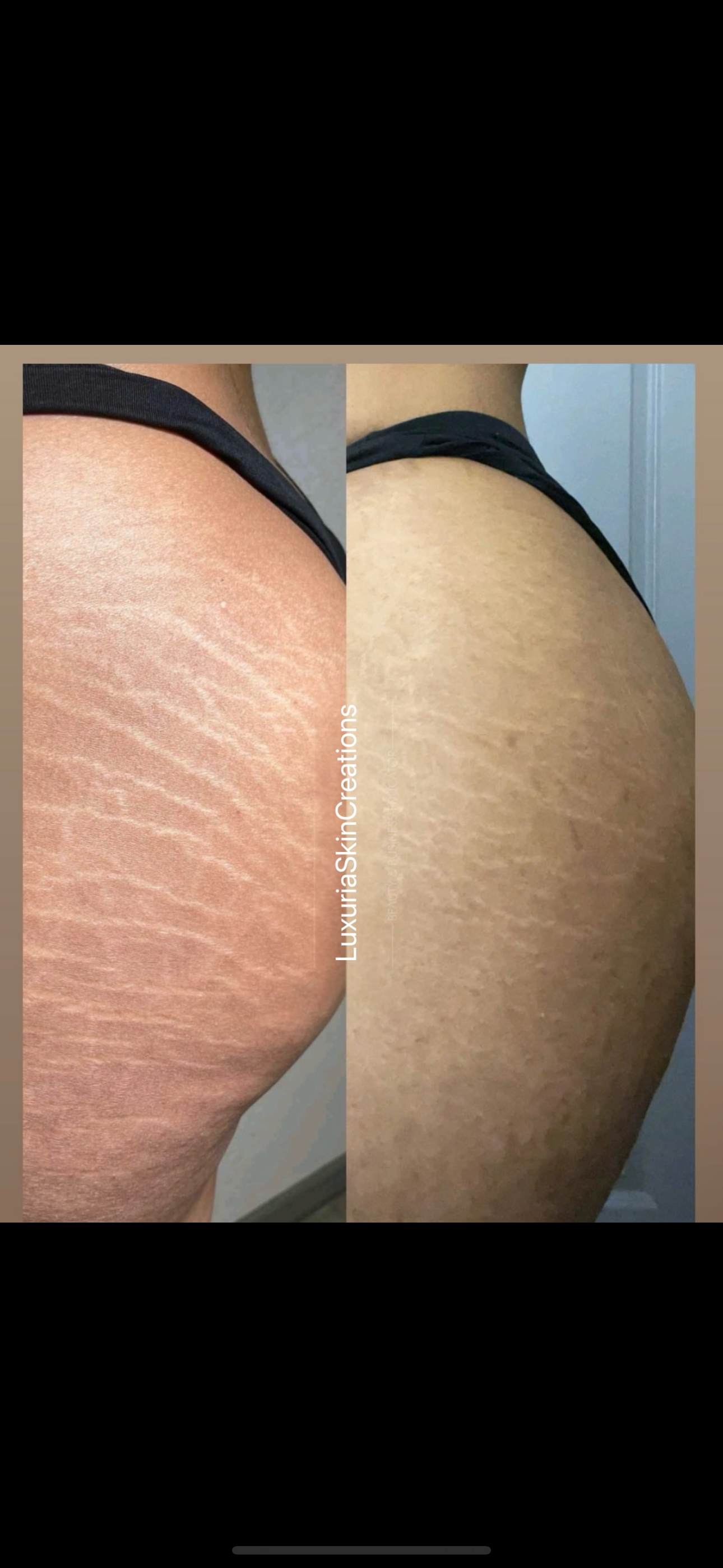 Stretch Mark & Scar Rejuvenation