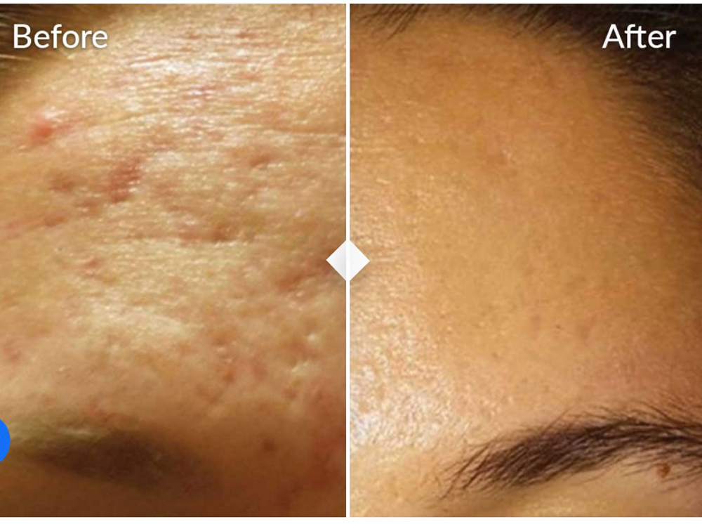 Microneedling Treatment (SkinPen) at Glam by Jozie in Waxahachie, TX